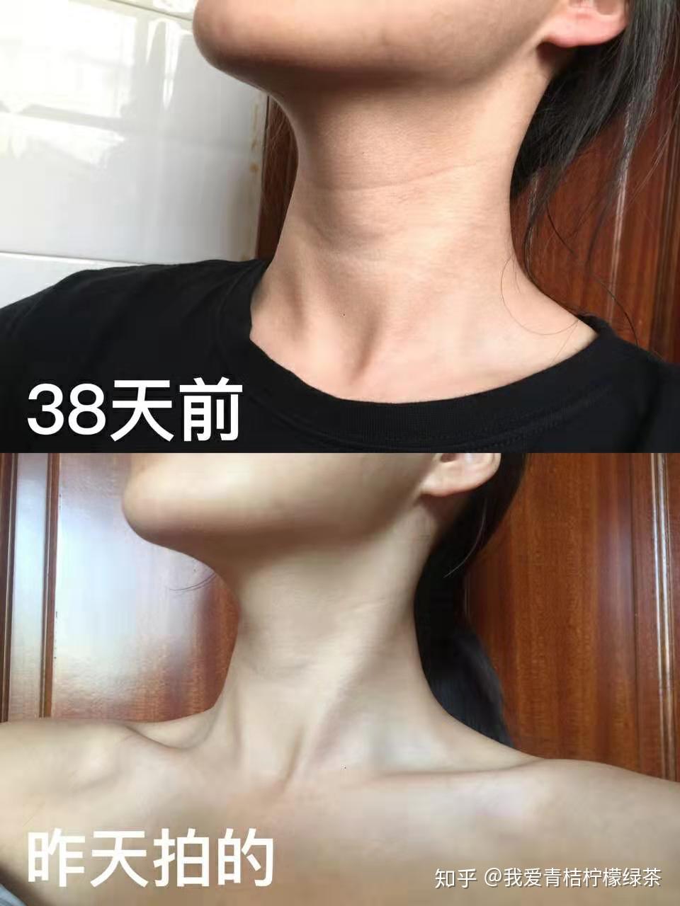 经常看到有说瘦脸,瘦腿,瘦腰的,如果脖子粗,怎么瘦脖子? - 知乎