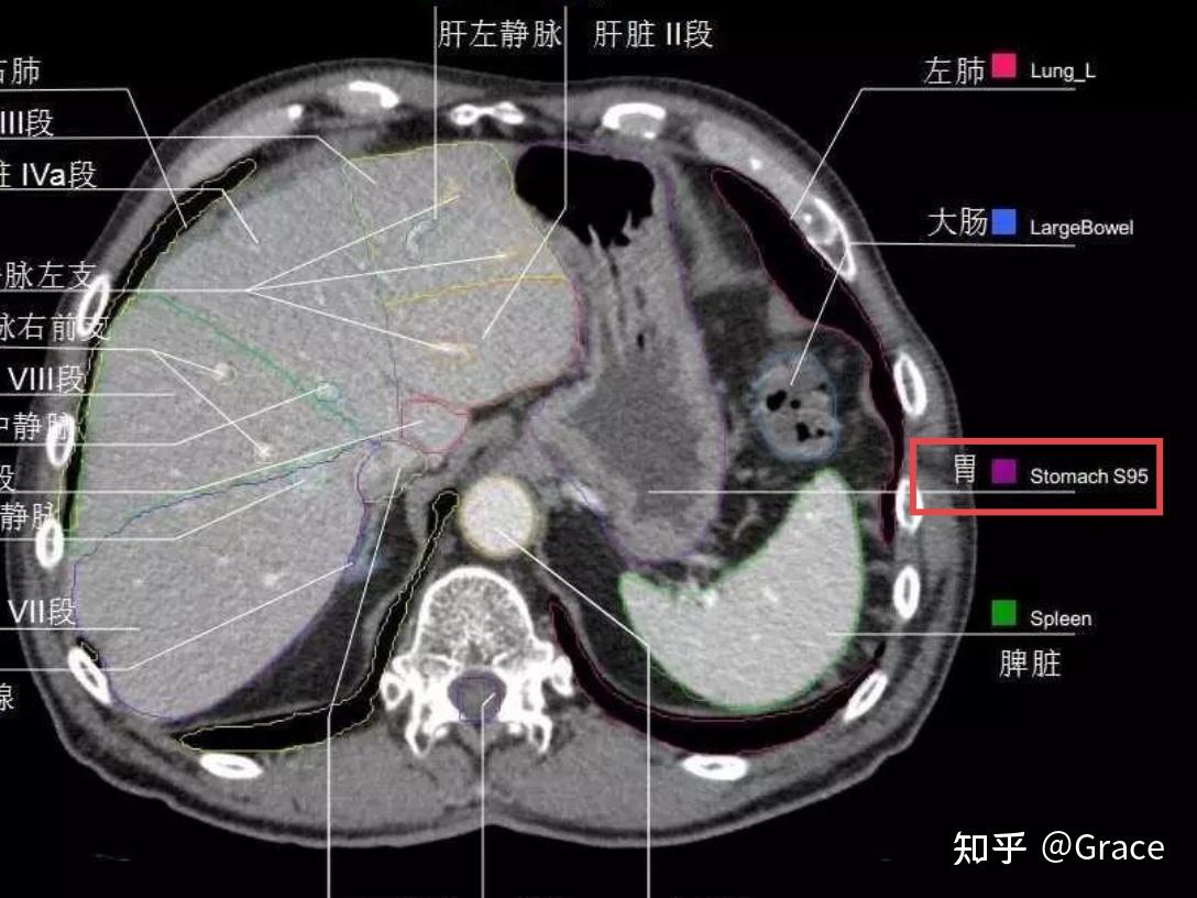 本人想做除胃镜以外的胃部的影像学检查，腹部CT检查包括胃部吗？还是归胸部CT检查呢？ - 知乎