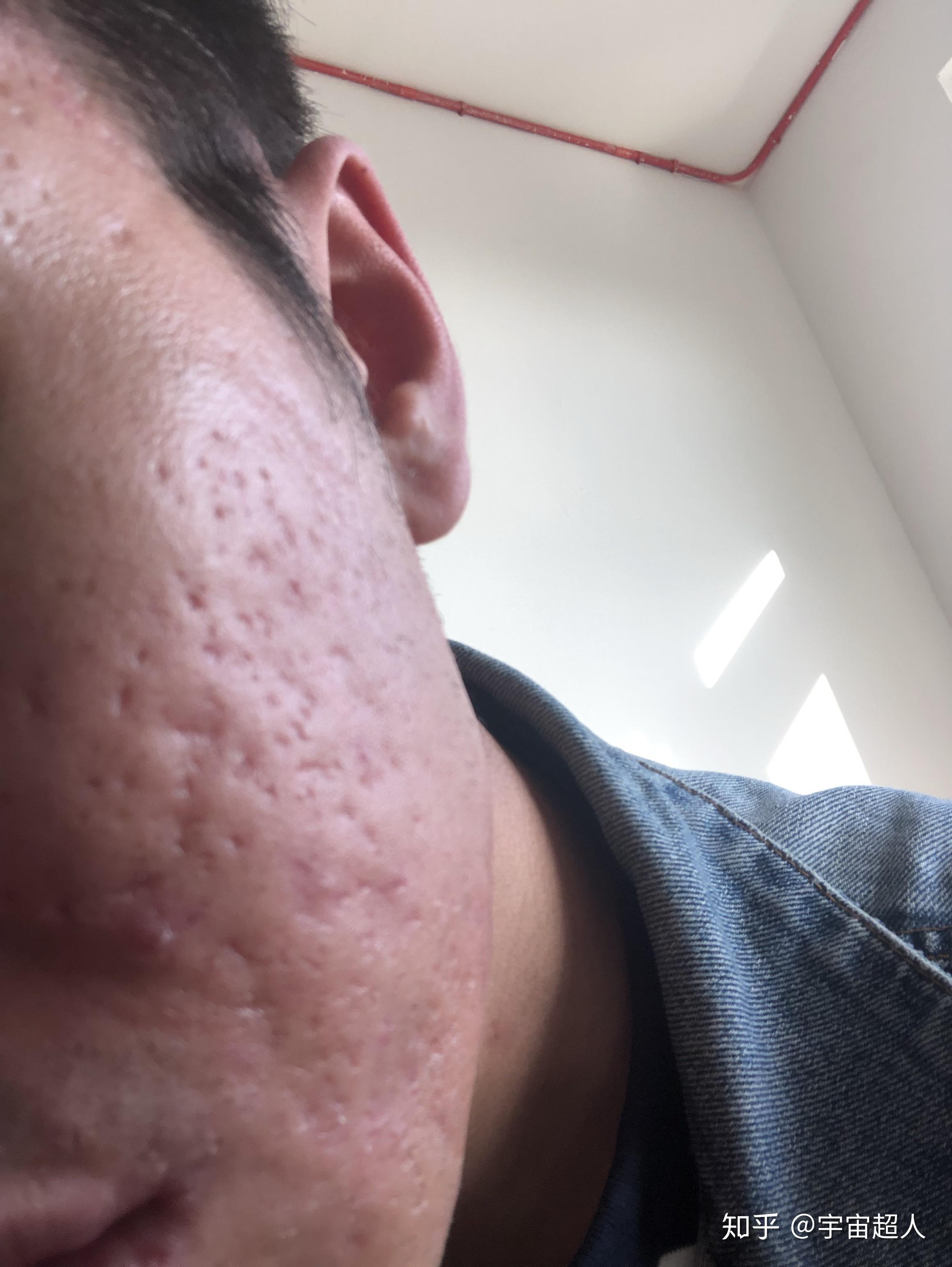 满脸痘坑的人都活得怎么样