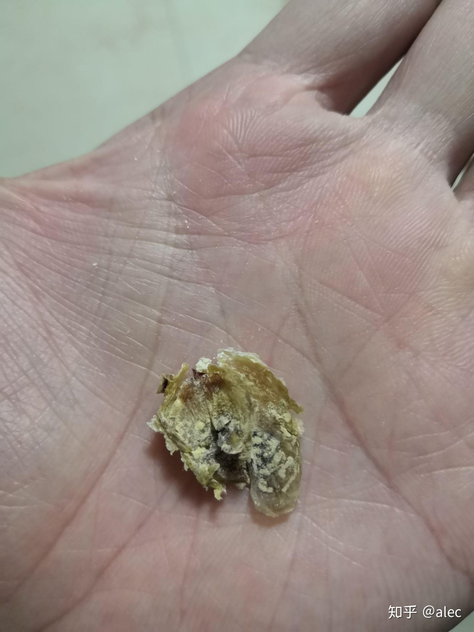 耳屎能大到什么程度? - 知乎