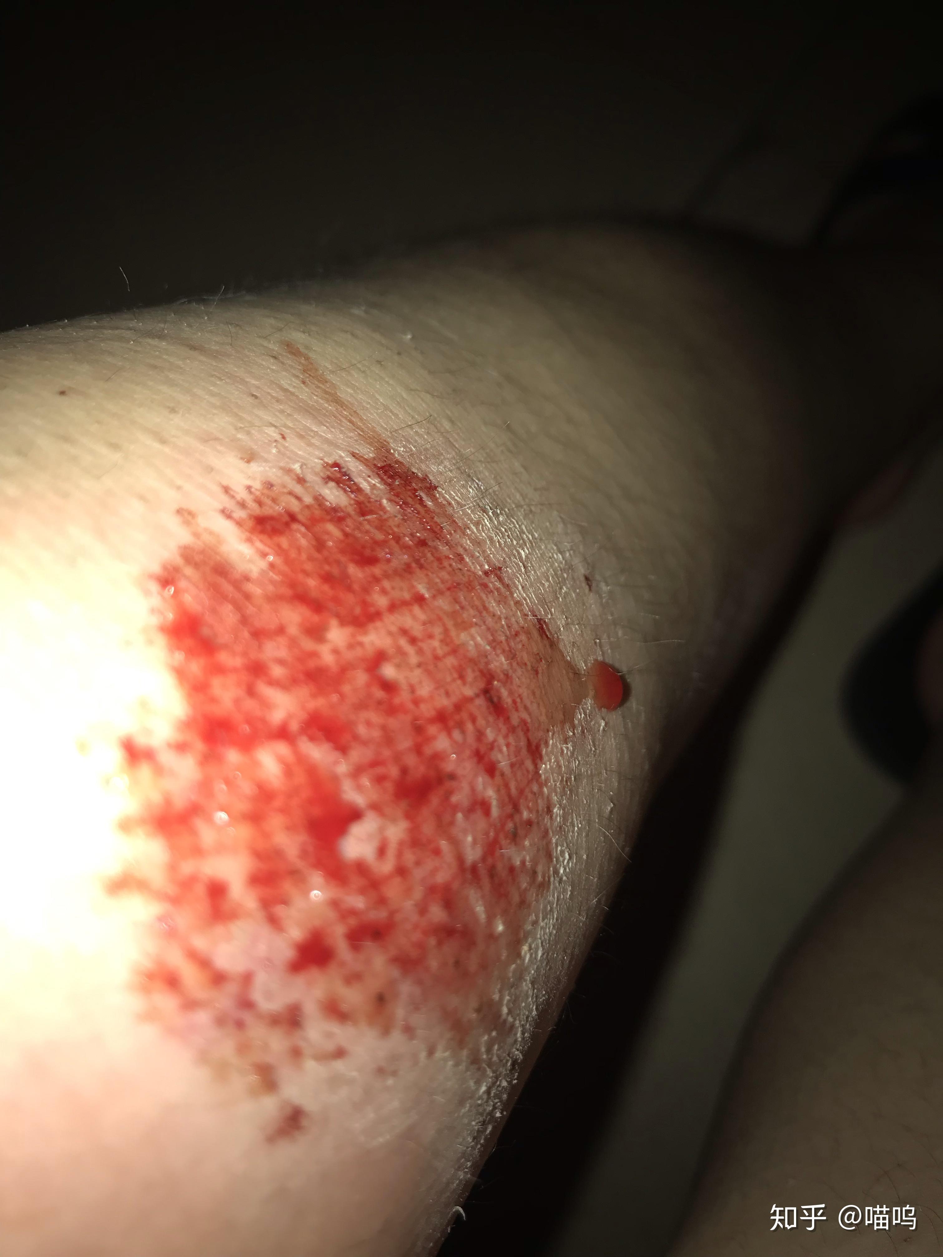 膝盖摔伤,抹了碘伏结痂后如何防止留疤?