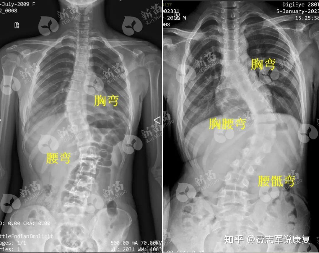 拍全脊柱x光的标准是什么? - 知乎