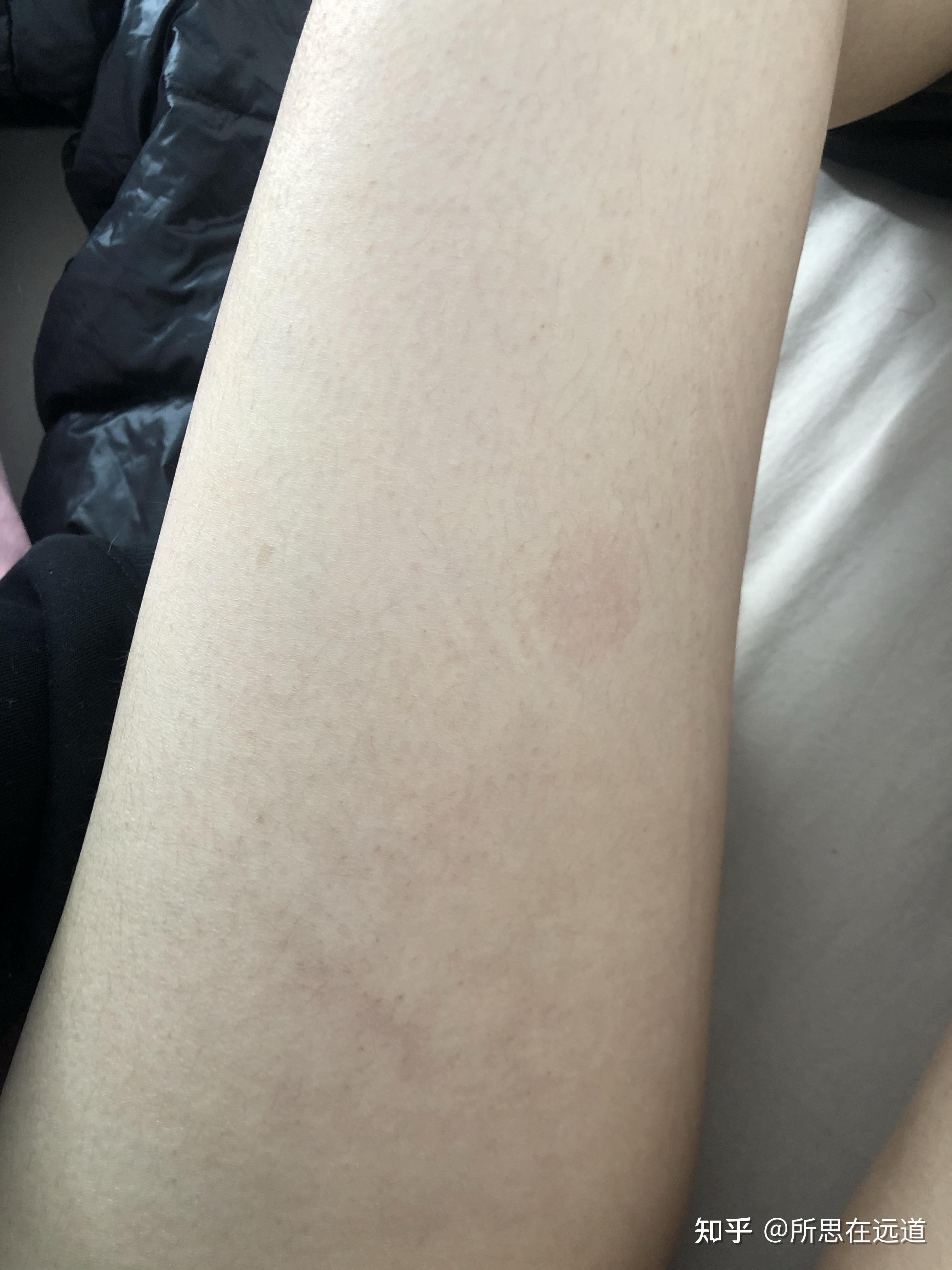 大腿内侧有红色网状条纹是怎么回事