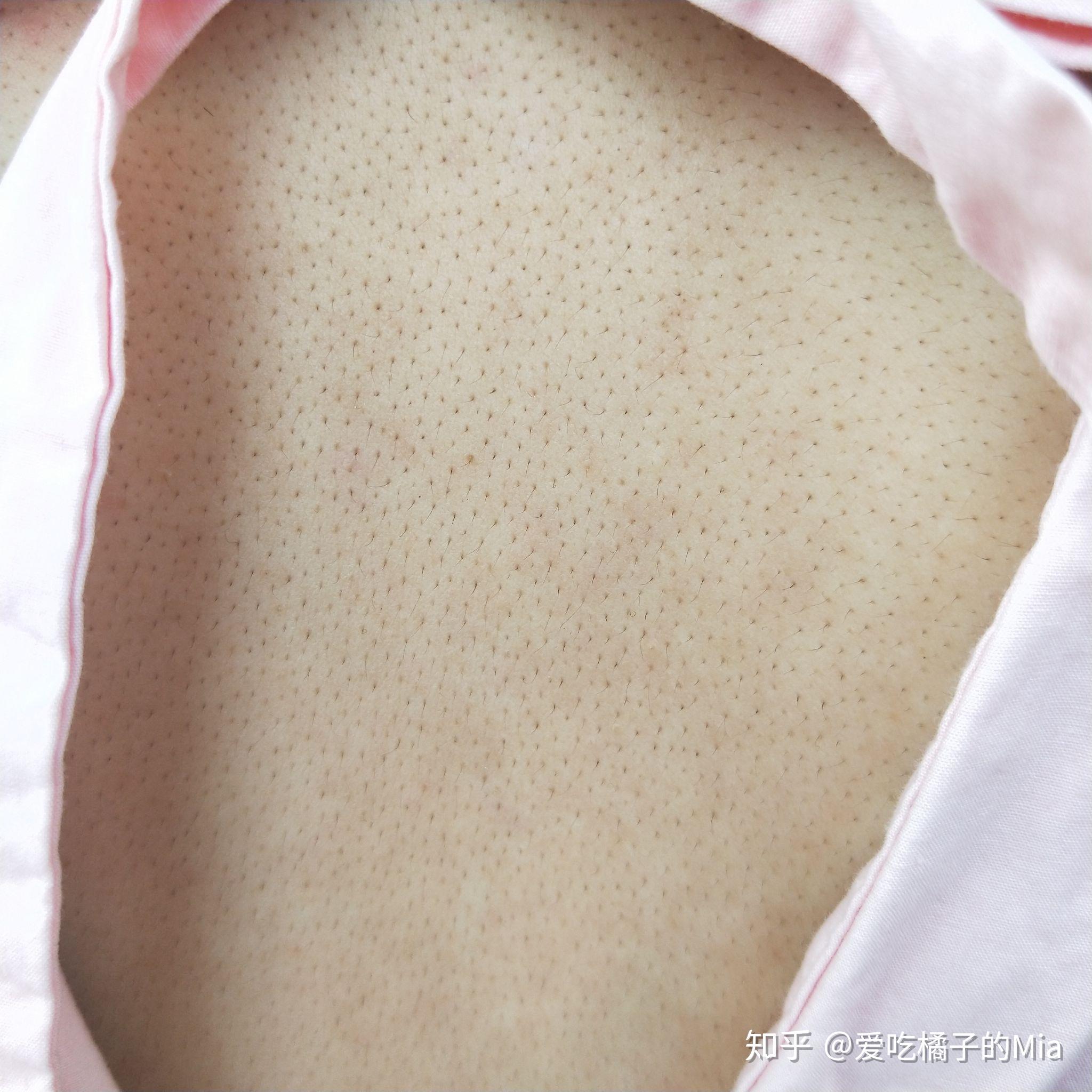 女生背上毛孔粗大怎么办