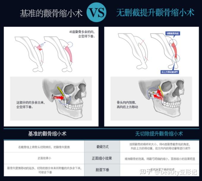 颧骨内推是什么原理图片