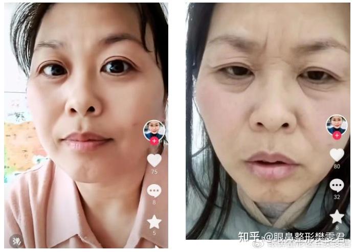 40多岁女人眼部衰老图片