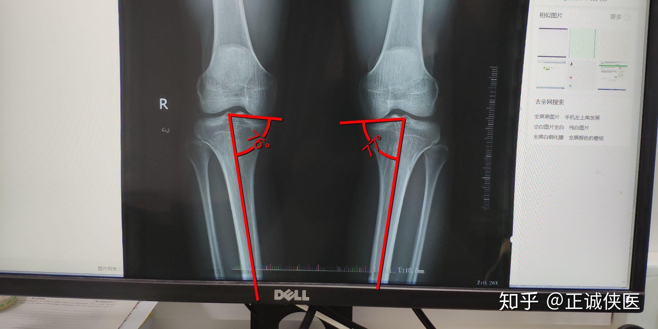 请问一下,从x光片上看,我的o型腿是关节畸形导致的还是肌肉力量问题啊