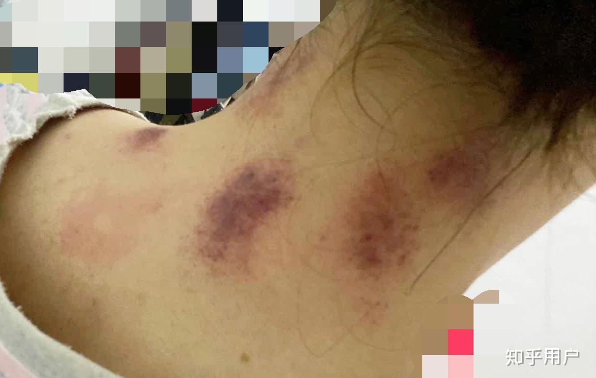 吻痕怎么快速消除啊? - 知乎