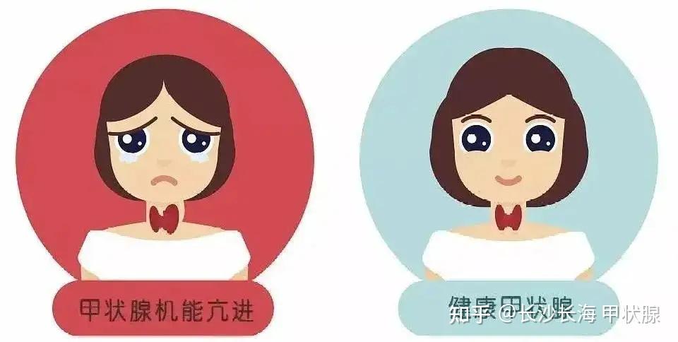 患上甲亢,身体会有哪些变化? - 知乎