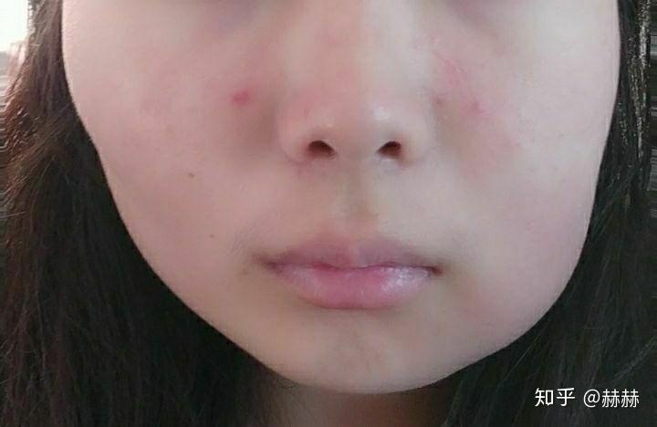 拔水平阻生智齿术后第二天脸肿了请问几天能消肿