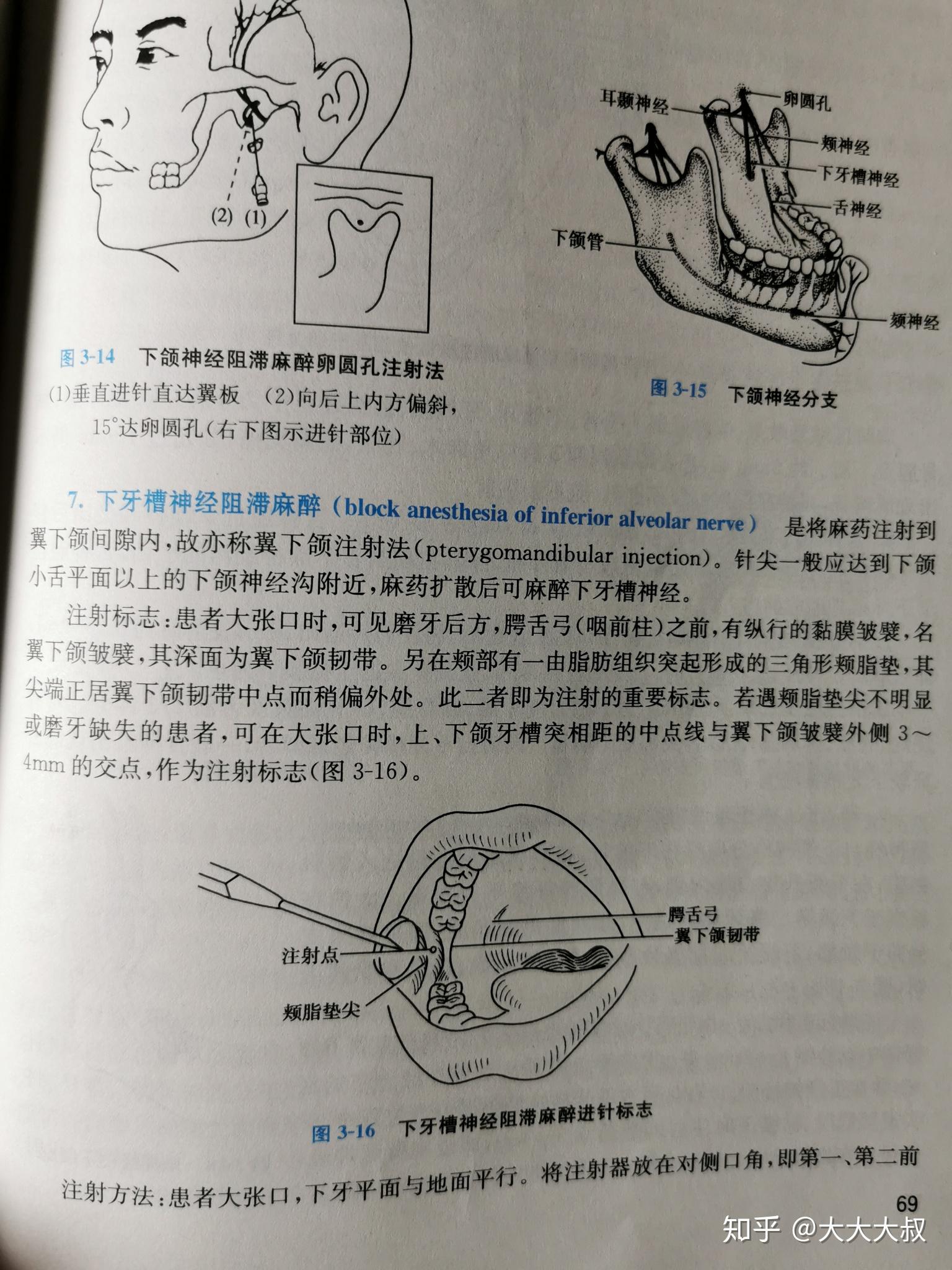 为什么根管治疗拔髓只需要在颊侧注射麻醉剂而腭侧不需要注射