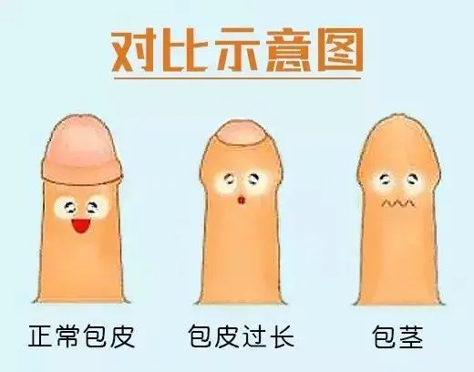 需要做儿童包皮手术的来了解一下过程