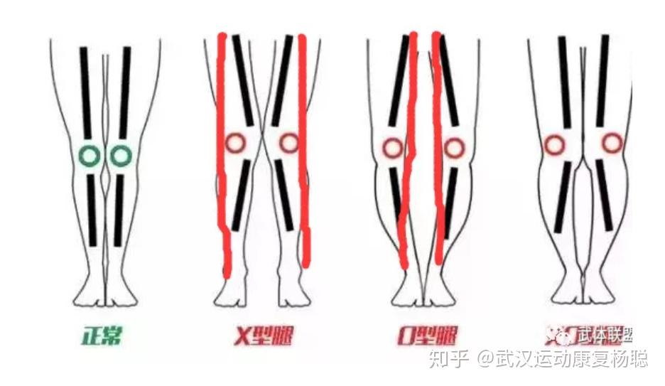 如何从解剖学的角度解释一下膝内翻、膝外翻、足内翻、足外翻的定义及成因? - 知乎