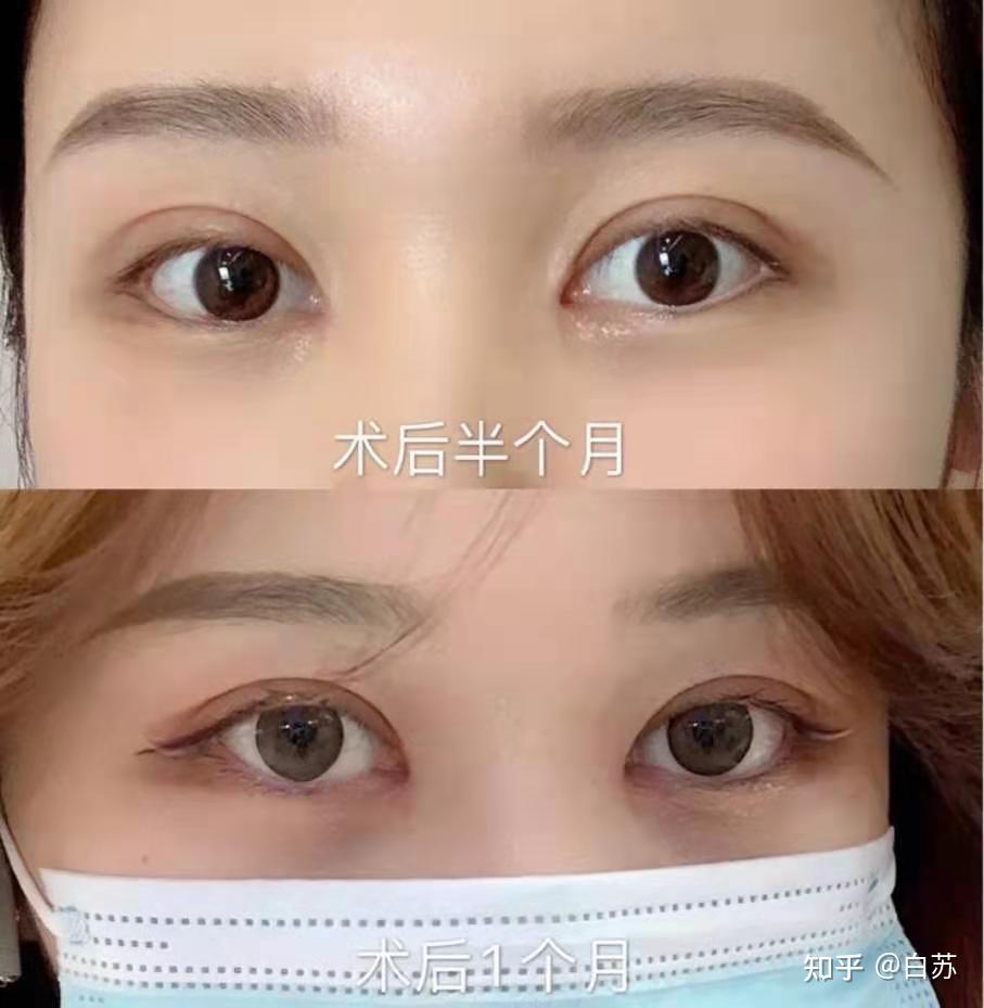 割双眼皮不开眼角是什么体验