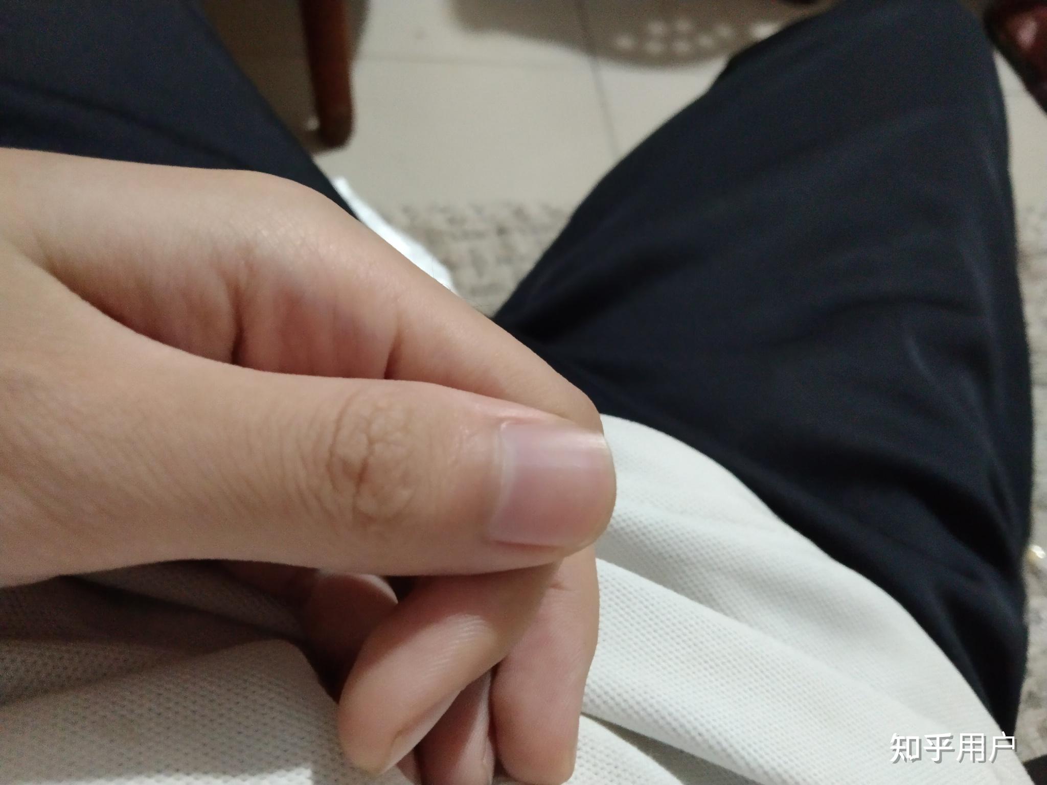 右手大拇指半个指甲盖下面的肉疼是怎么回事一碰就更疼