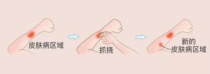 皮肤瘙痒抓挠会坏事，这样做快速止痒 - 知乎