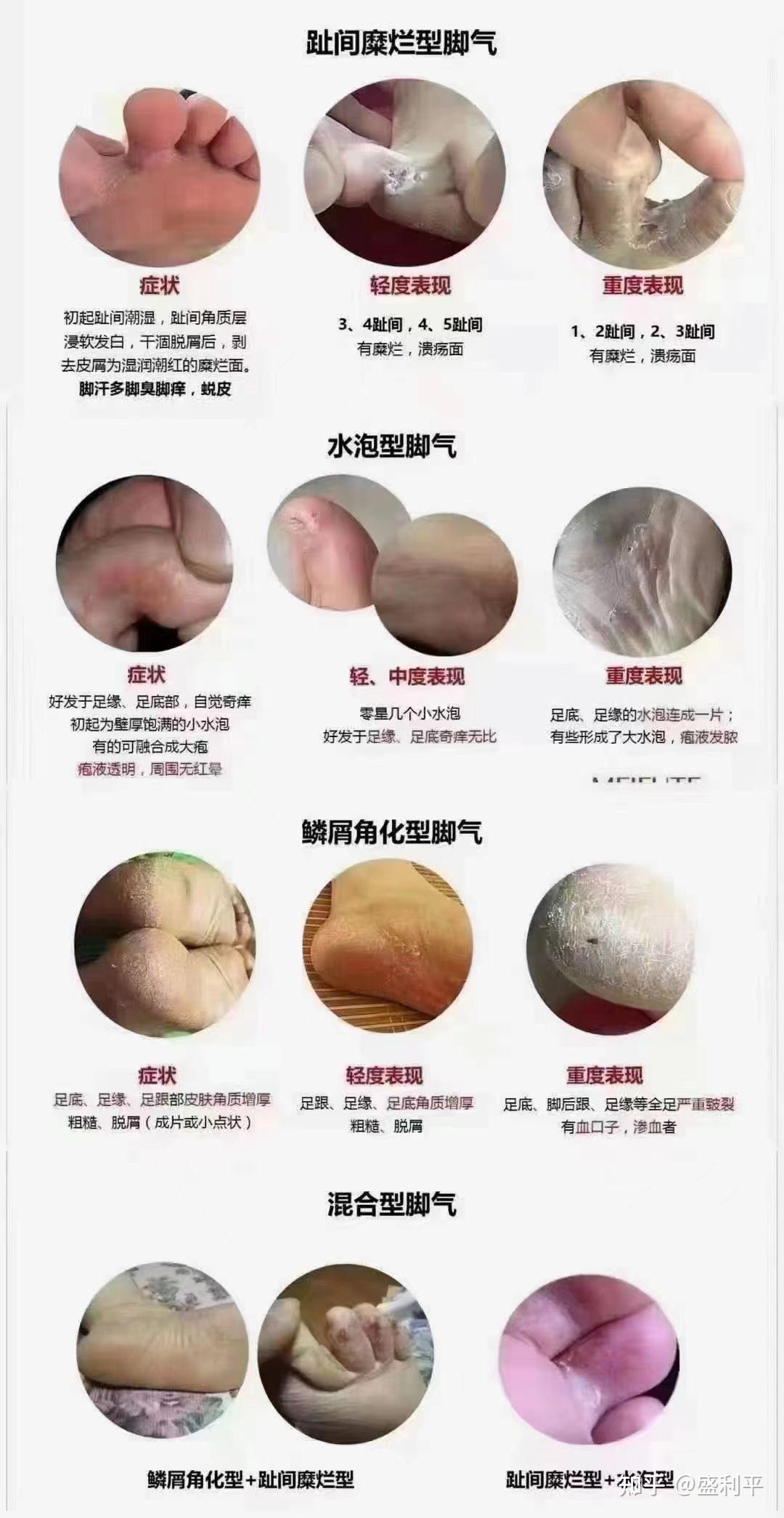 关注问题 写回答 登录/注册 脚气 治脚气 足癣 去脚气 脚气咋办