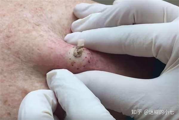 我该拿这个巨大的黑头怎么办?