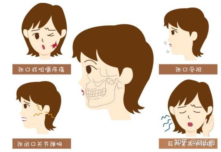 张大嘴巴口腔咔咔响，可能是颞下颌关节紊乱症 - 知乎