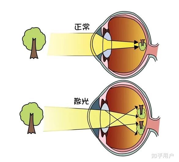 200度散光是什么感觉? - 知乎