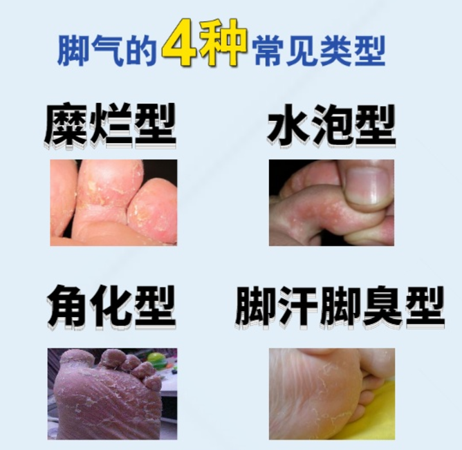 说说你是怎么治好脚气的? - 知乎