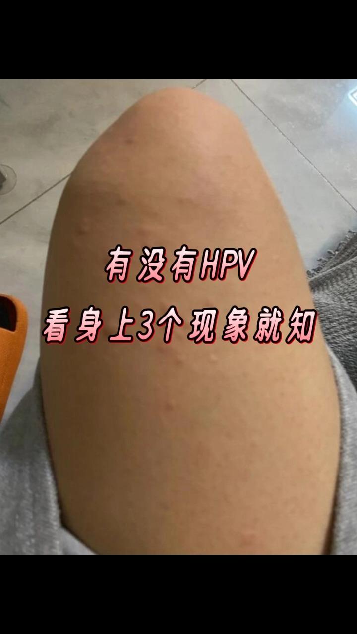 有没有hpv看看身上3个现象就知道