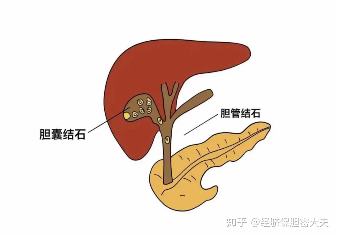 胆管结石vs胆囊结石，区别到底在什么地方？ - 知乎