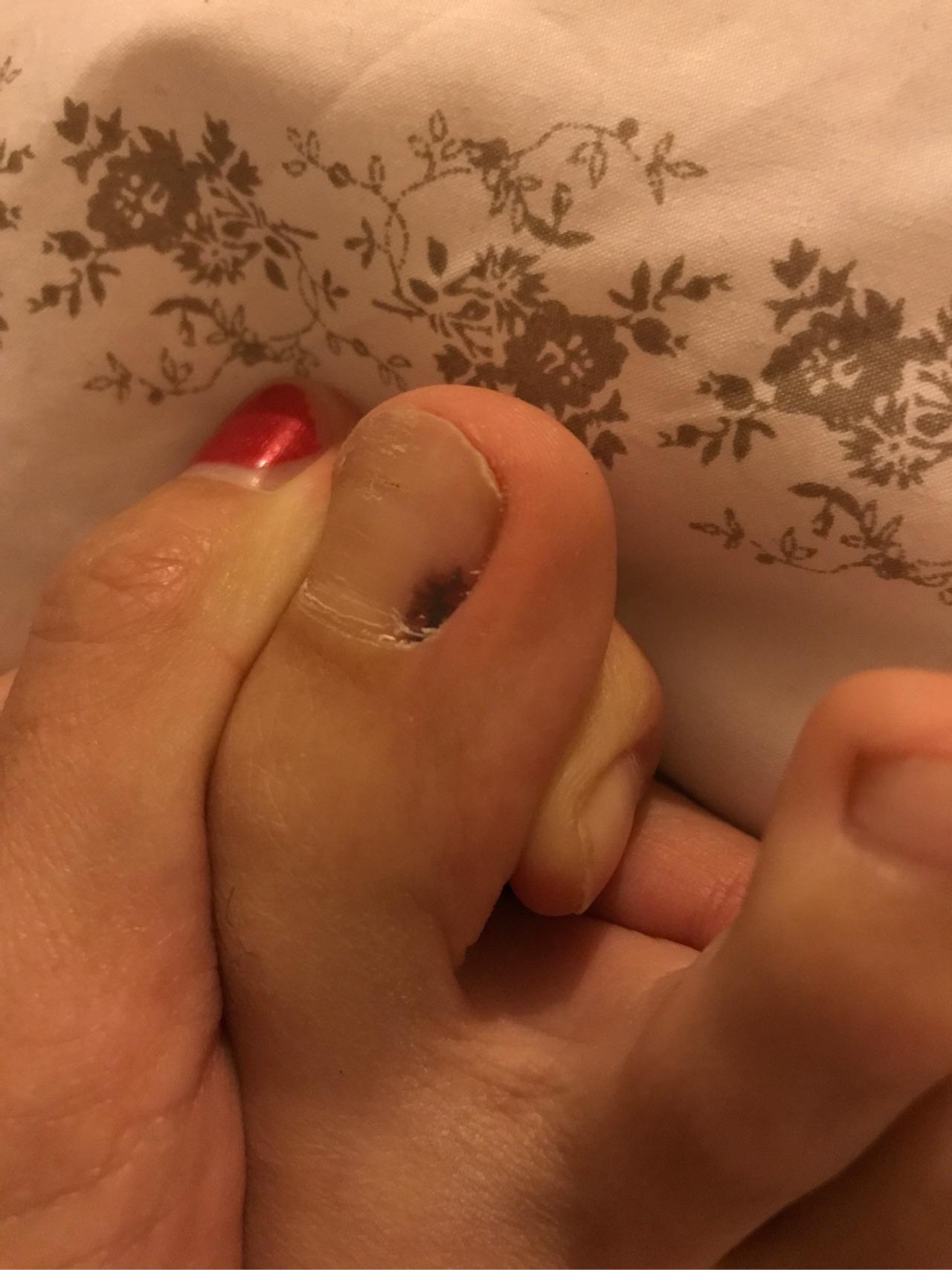 左右脚的大拇指,分别长了一个黑斑,位置相同,是黑色素瘤吗?