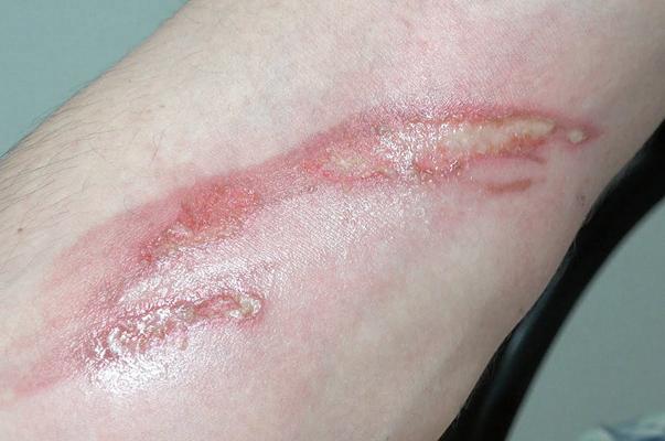 烧伤疤痕增生疼痛该怎么处理