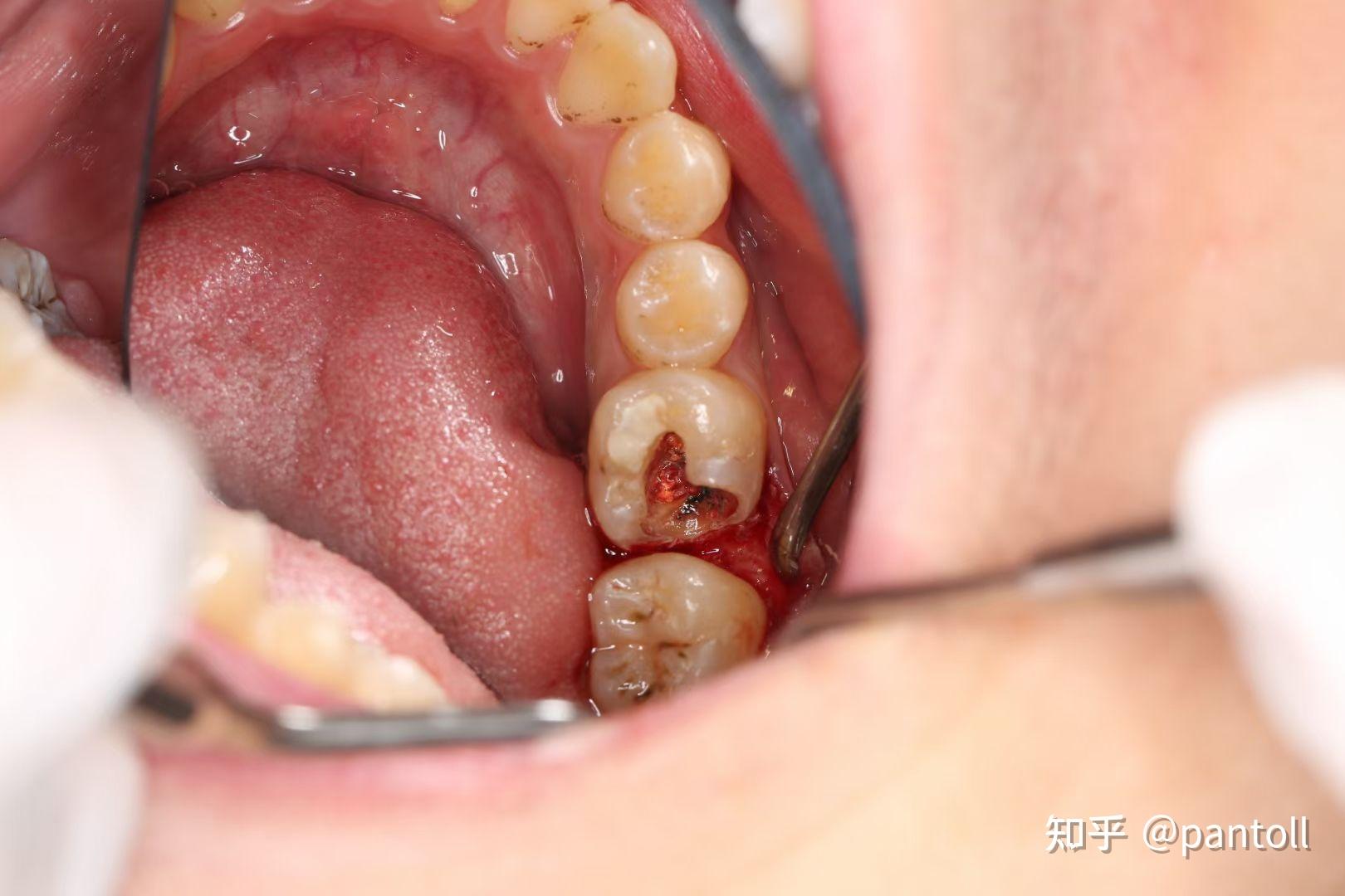 牙齿空了黑了怎么办? - 知乎