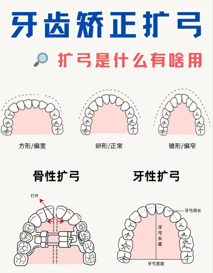 正畸大揭秘:MSE骨性扩弓 vs 传统正畸,你真的了解吗? - 知乎