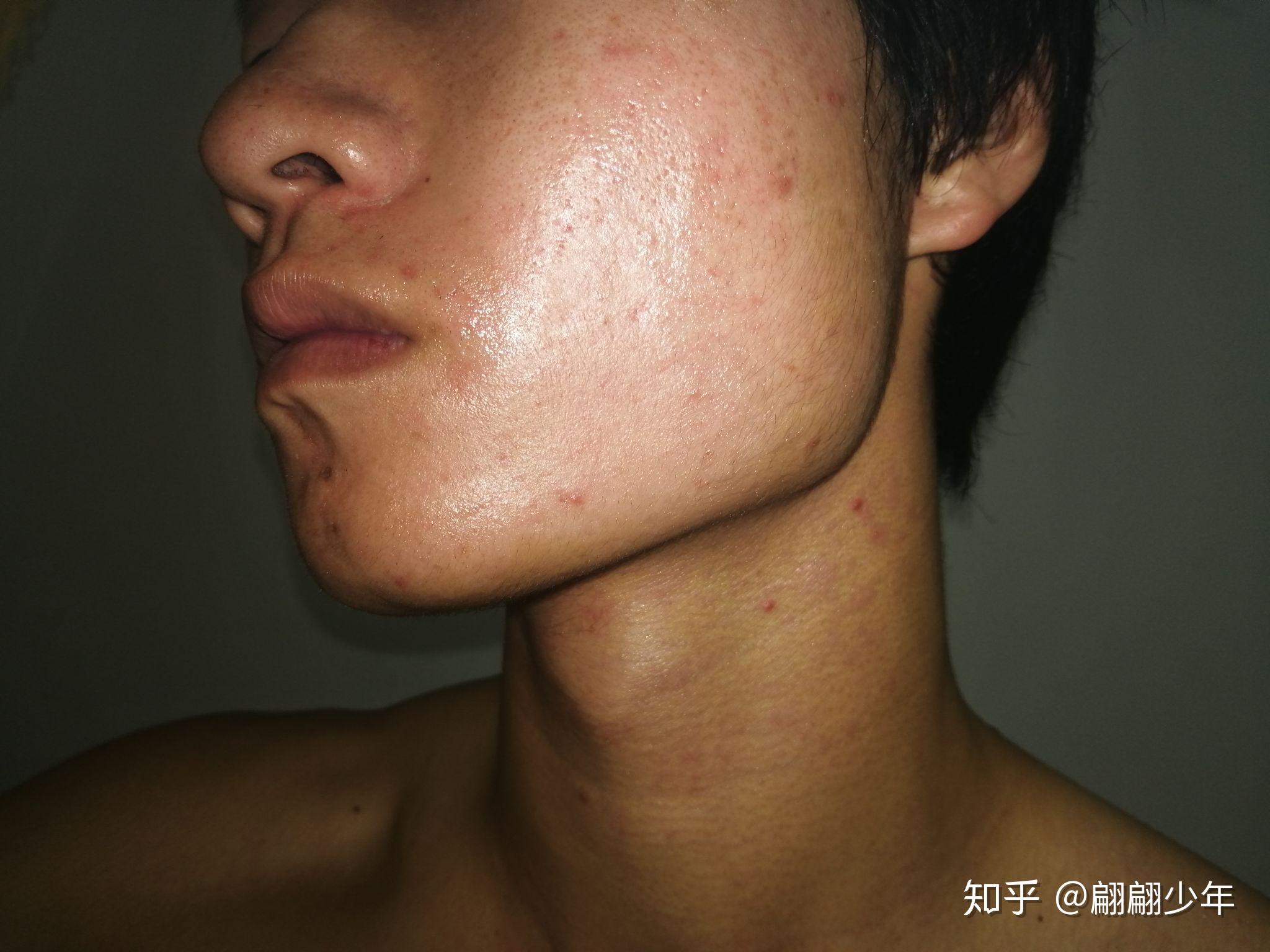 阿达帕林凝胶灼烧蜕皮? - 知乎