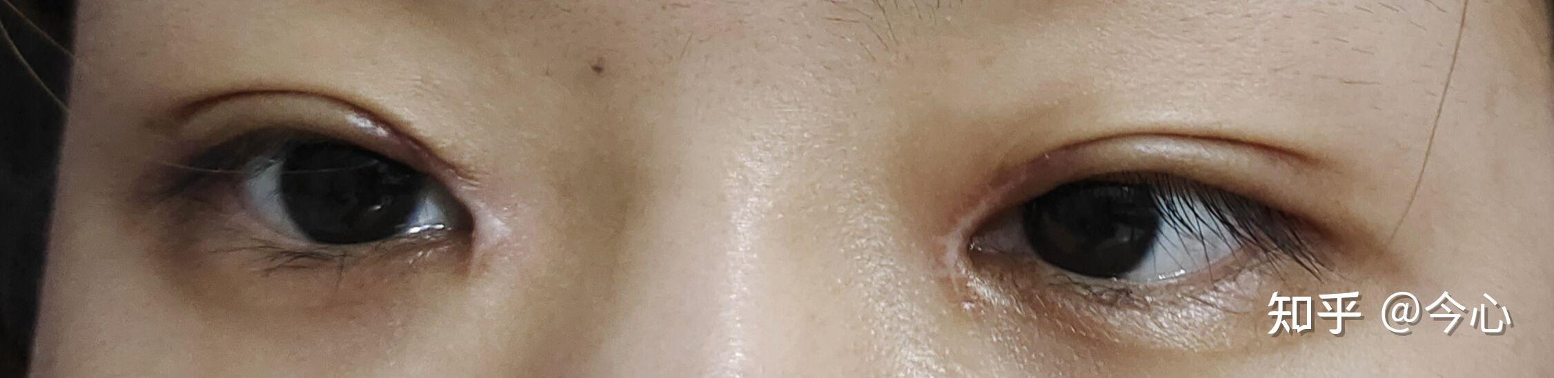 全切双眼皮加开眼角两个月了眼角白色疤痕明显请问各位这个情况需要