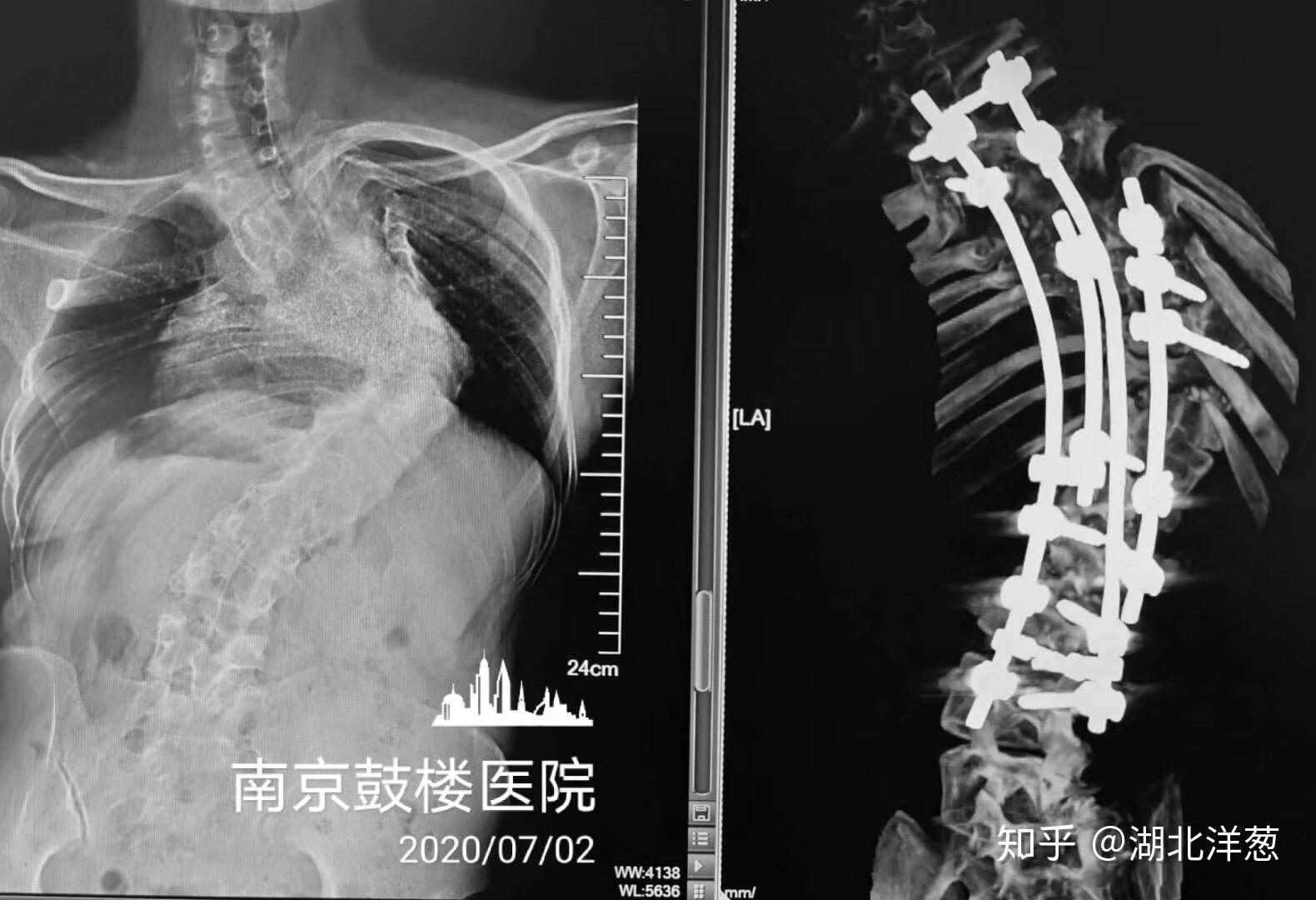脊柱后凸自我矫正法_脊柱后凸矫正手术后遗症_矫形脊柱后凸畸形手术