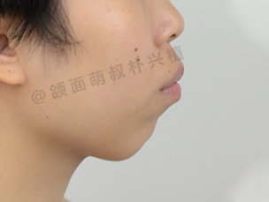 想要解决嘴凸的问题,先要了解什么????@颌面萌叔朴兴植 - 知乎