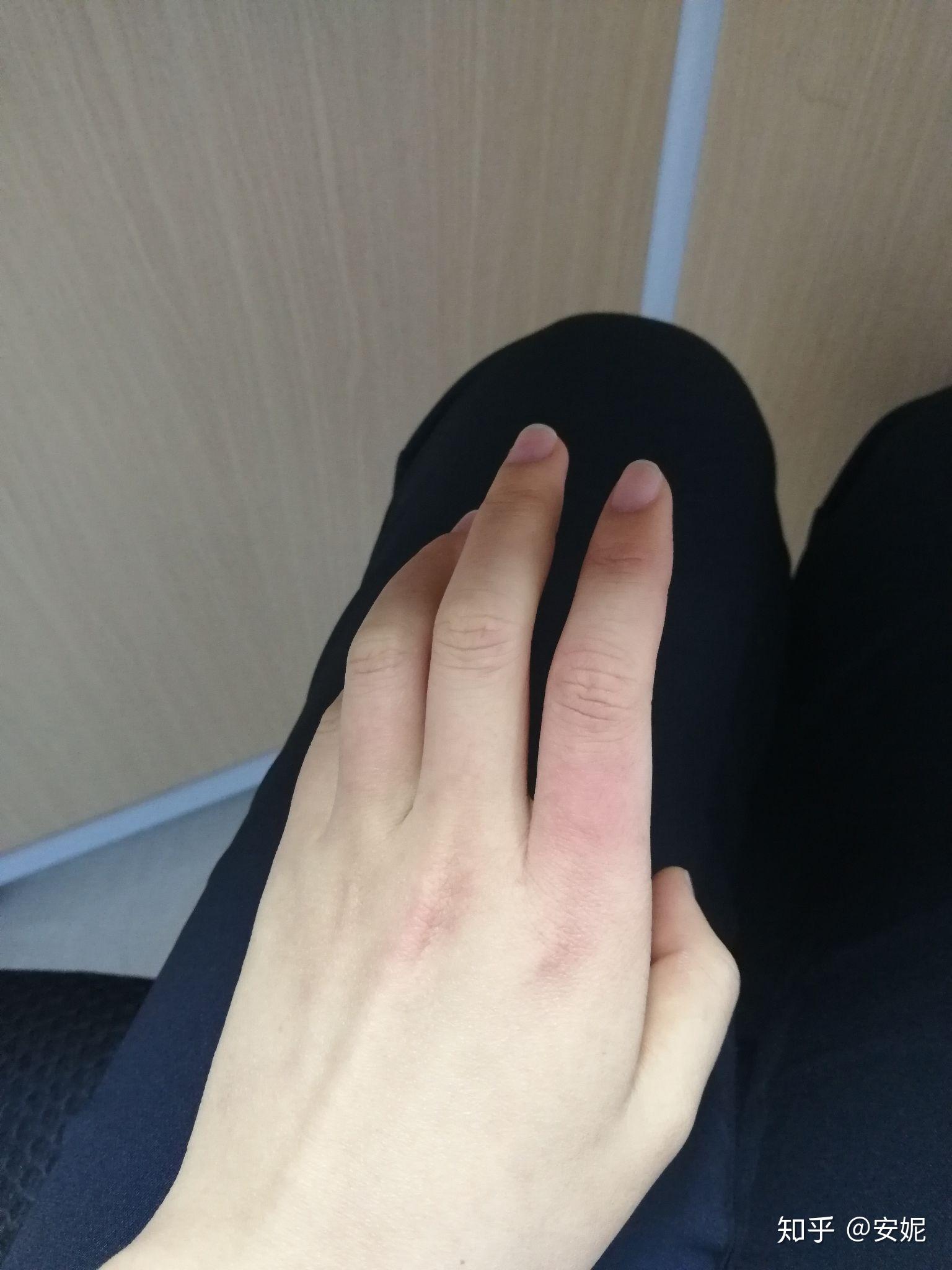皮肤一冷就发紫浑身都是这样温度越高越白皙宝宝略痘印冻紫我的天恁们