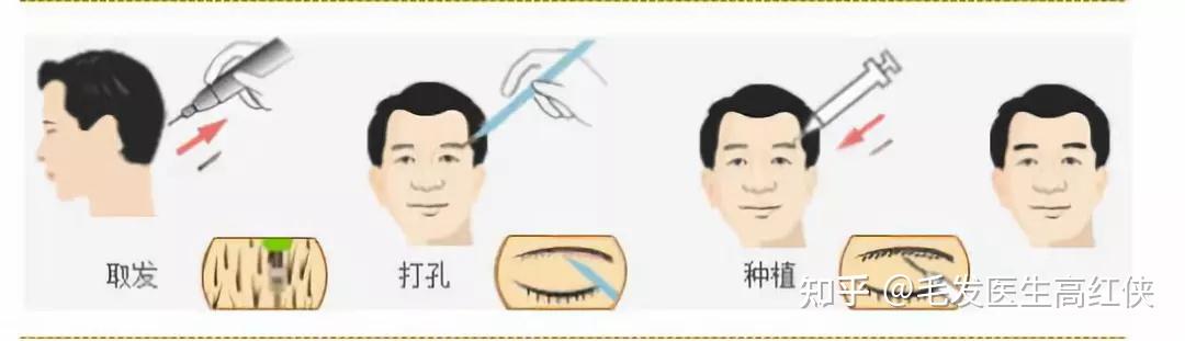 毛发种植价格表大全最新