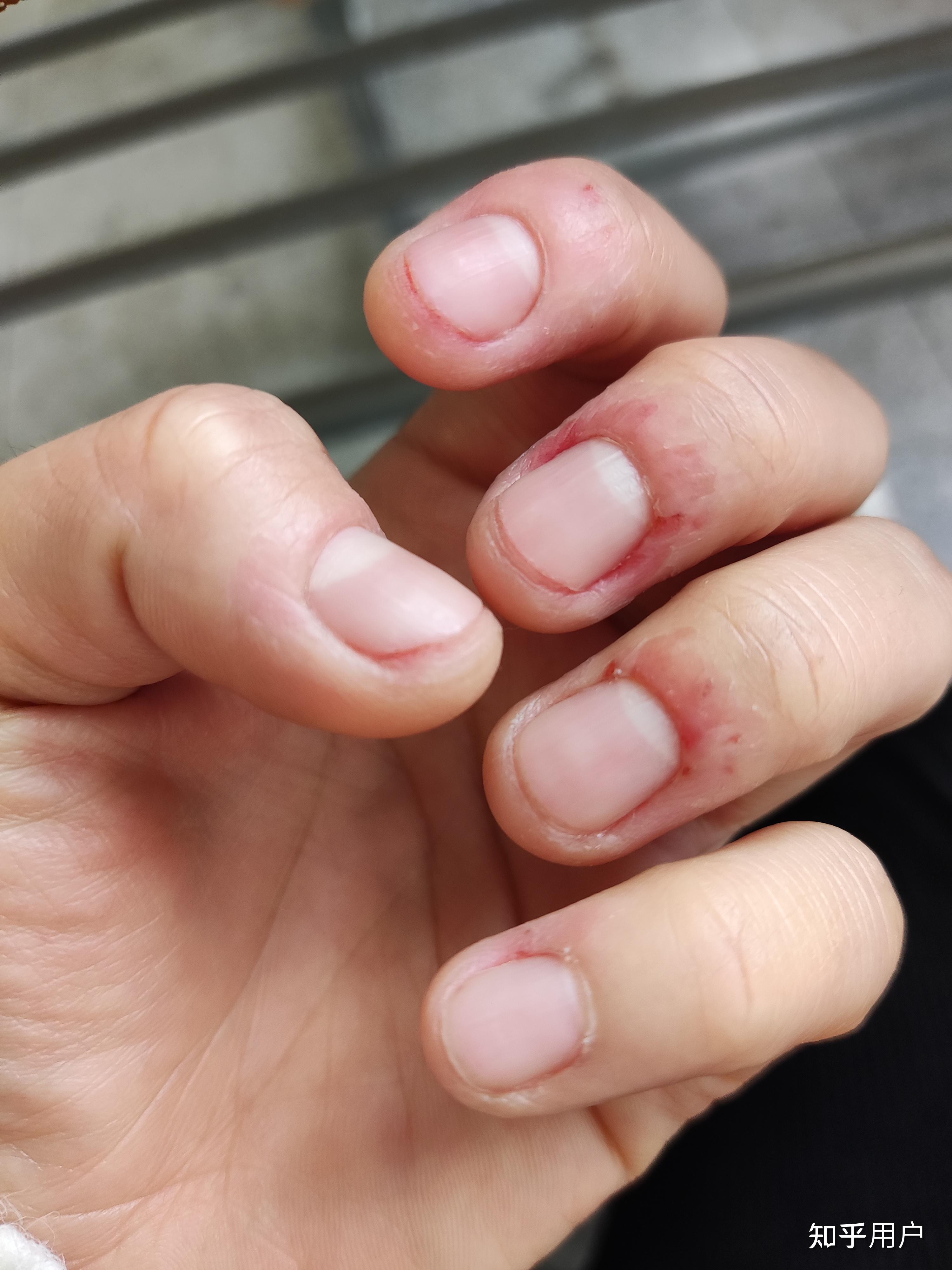 喜欢抠手,都抠破几层皮了,我还是个女孩子,怎么办? - 知乎