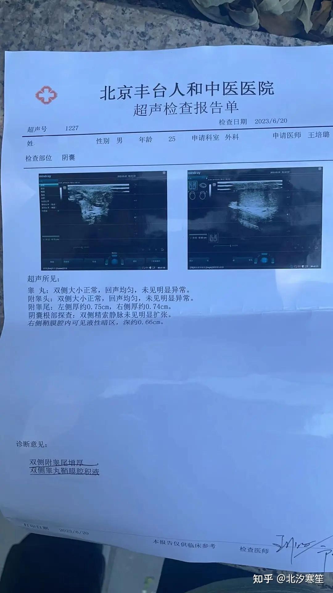 精索静脉曲张手术要多少费用