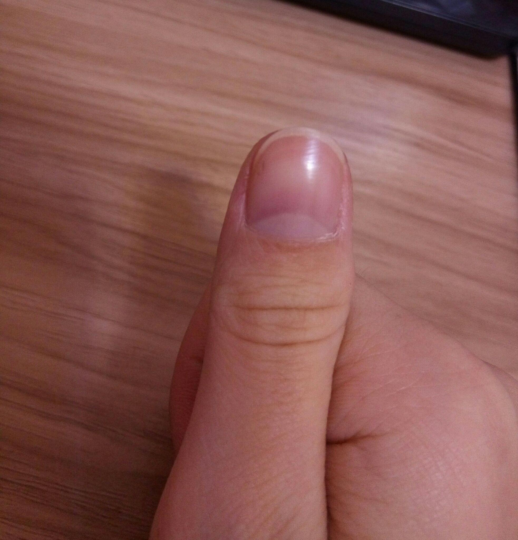 指甲上有一条淡淡黑线,怎么回事?两年了. - 知乎