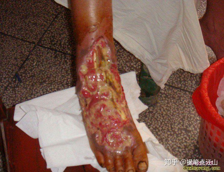 五步蛇名字由何而来被咬了后真的只能走五步吗