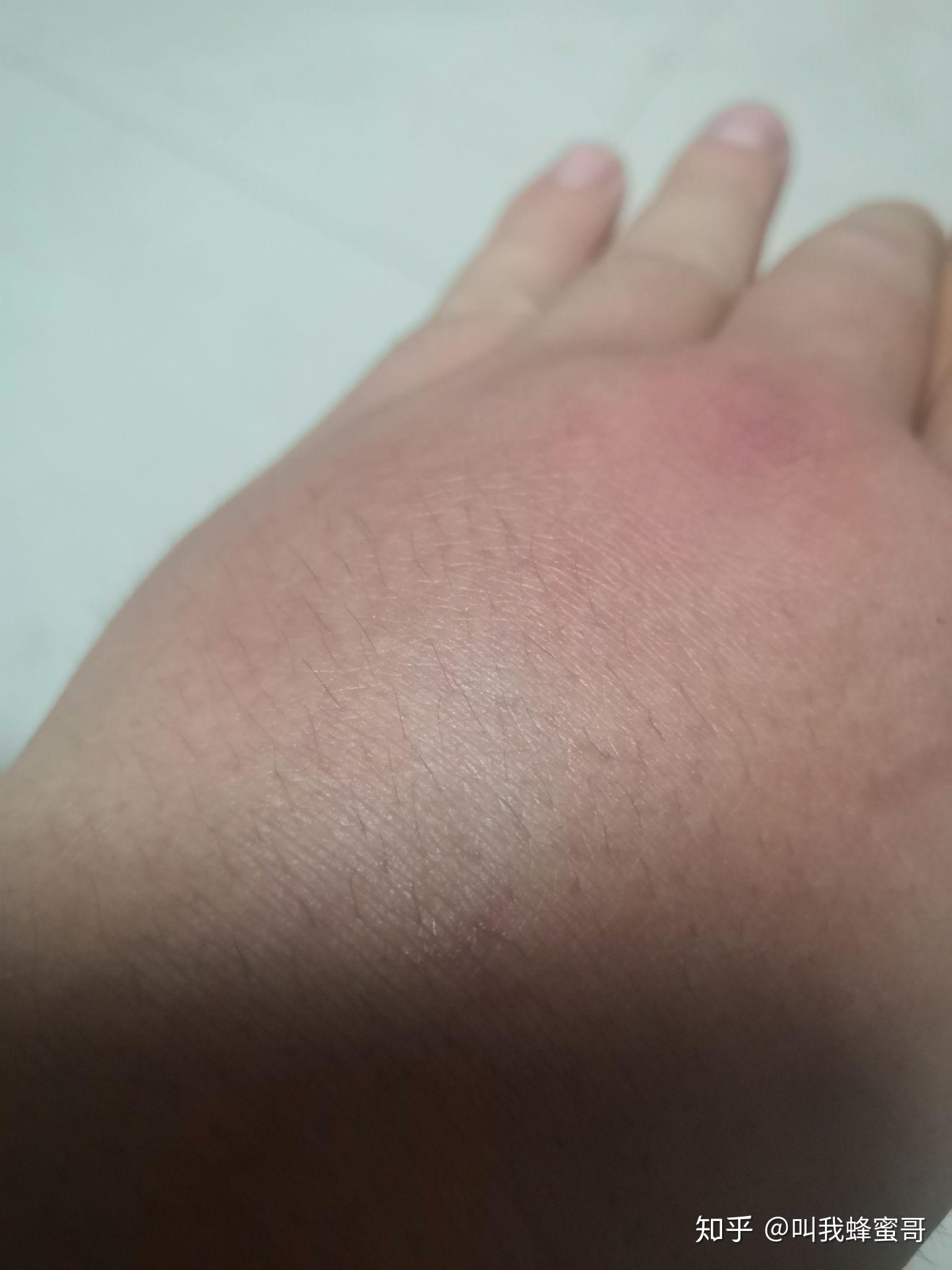 被蜜蜂蛰之后该怎么办