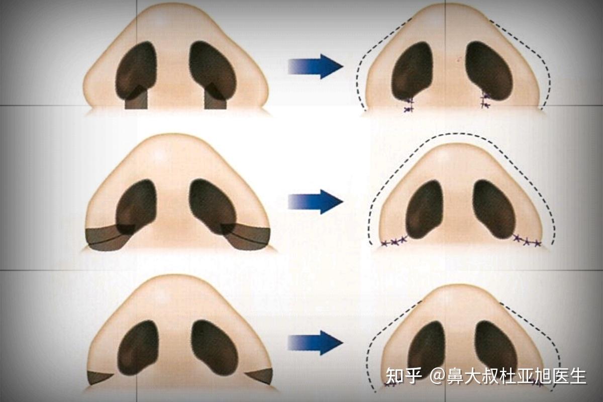 鼻翼缩小内切和外切的区别,你造吗? - 知乎