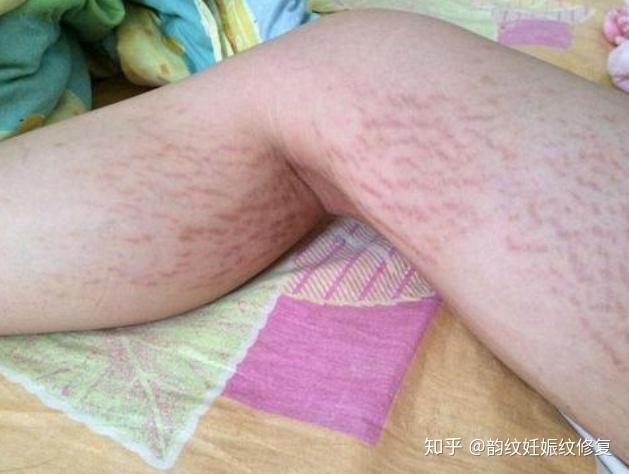 妊辰纹都是在肚子上吗