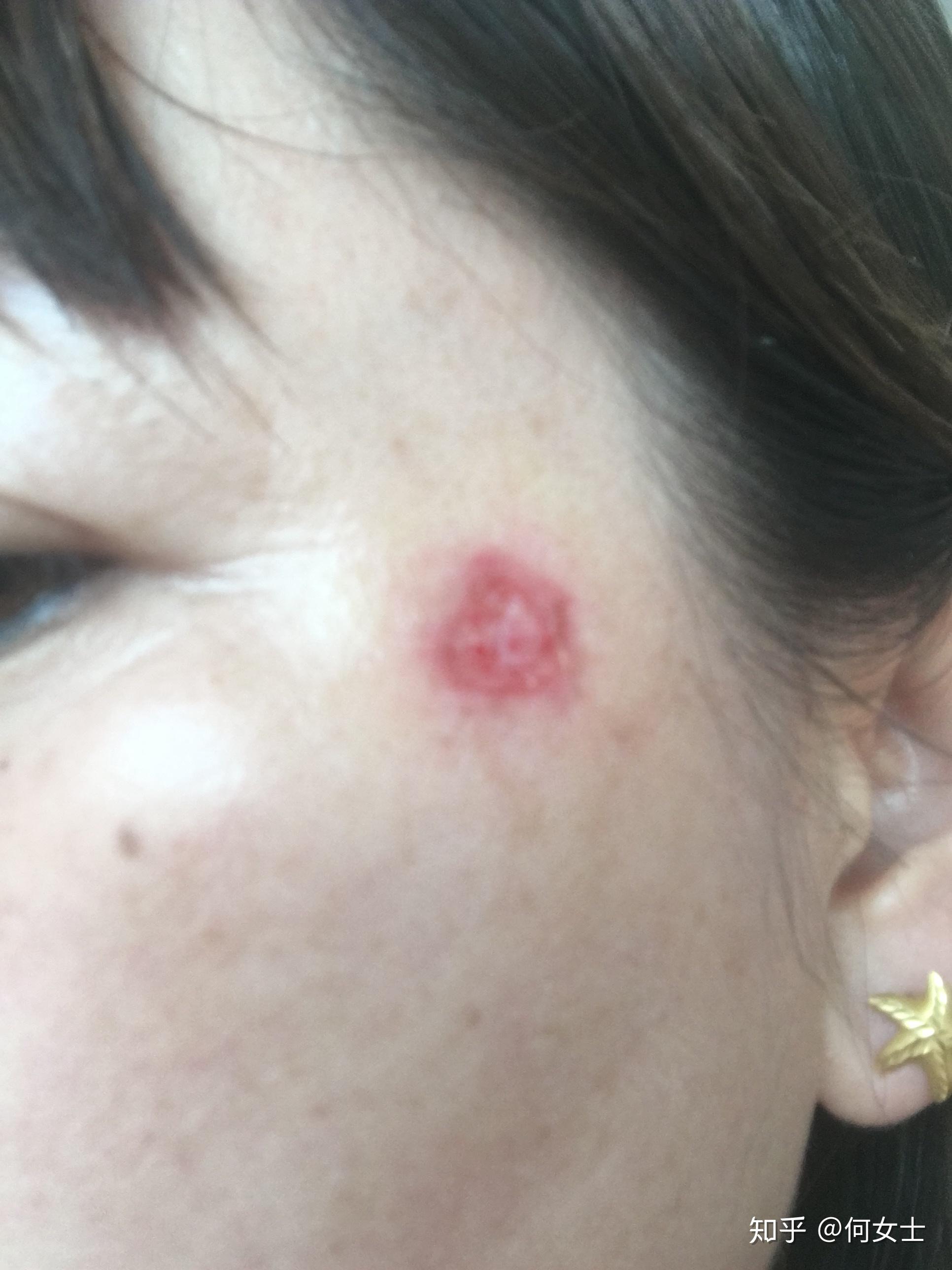 为什么点完痣用了两天消毒液后用修复液一涂修复液就流脓