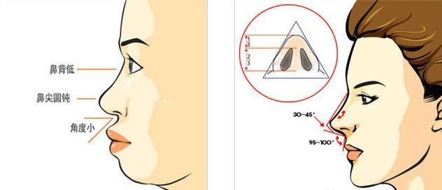 塌鼻、宽鼻翼、肥鼻头,还有救吗? - 知乎