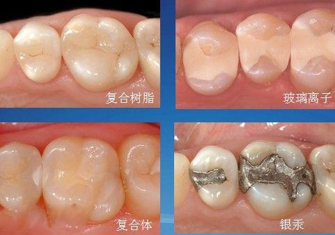 补牙到底选择哪种材料? - 知乎