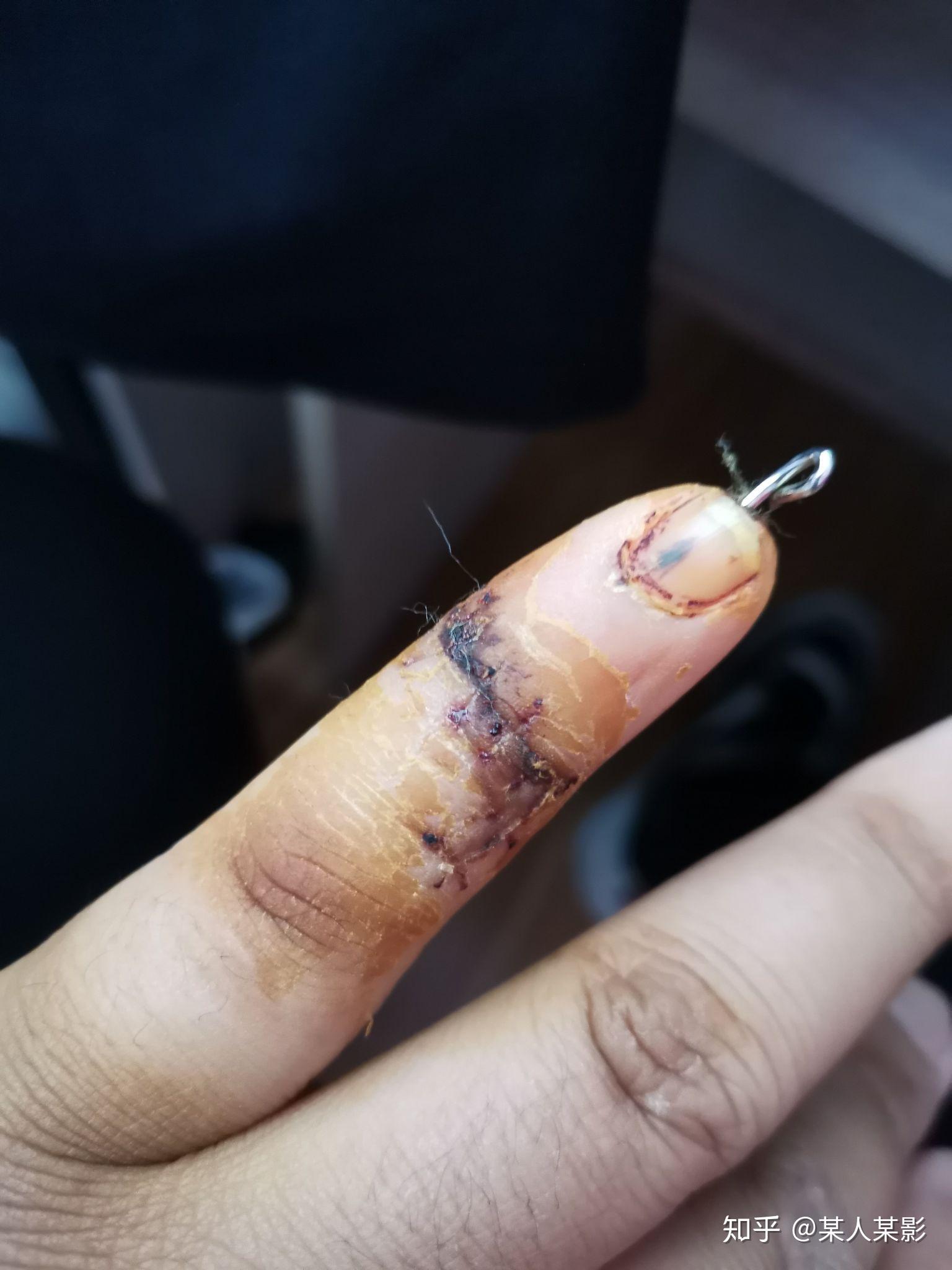 手指切断了还能康复吗