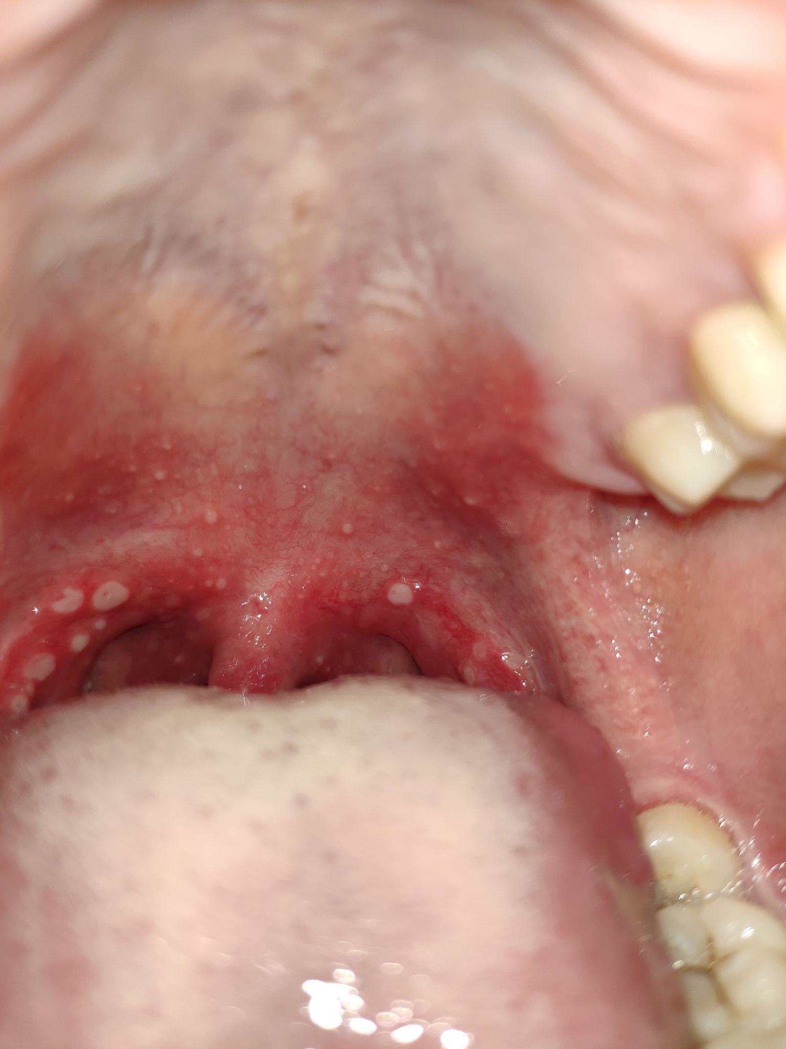 喉咙内壁有白色溃疡状图片