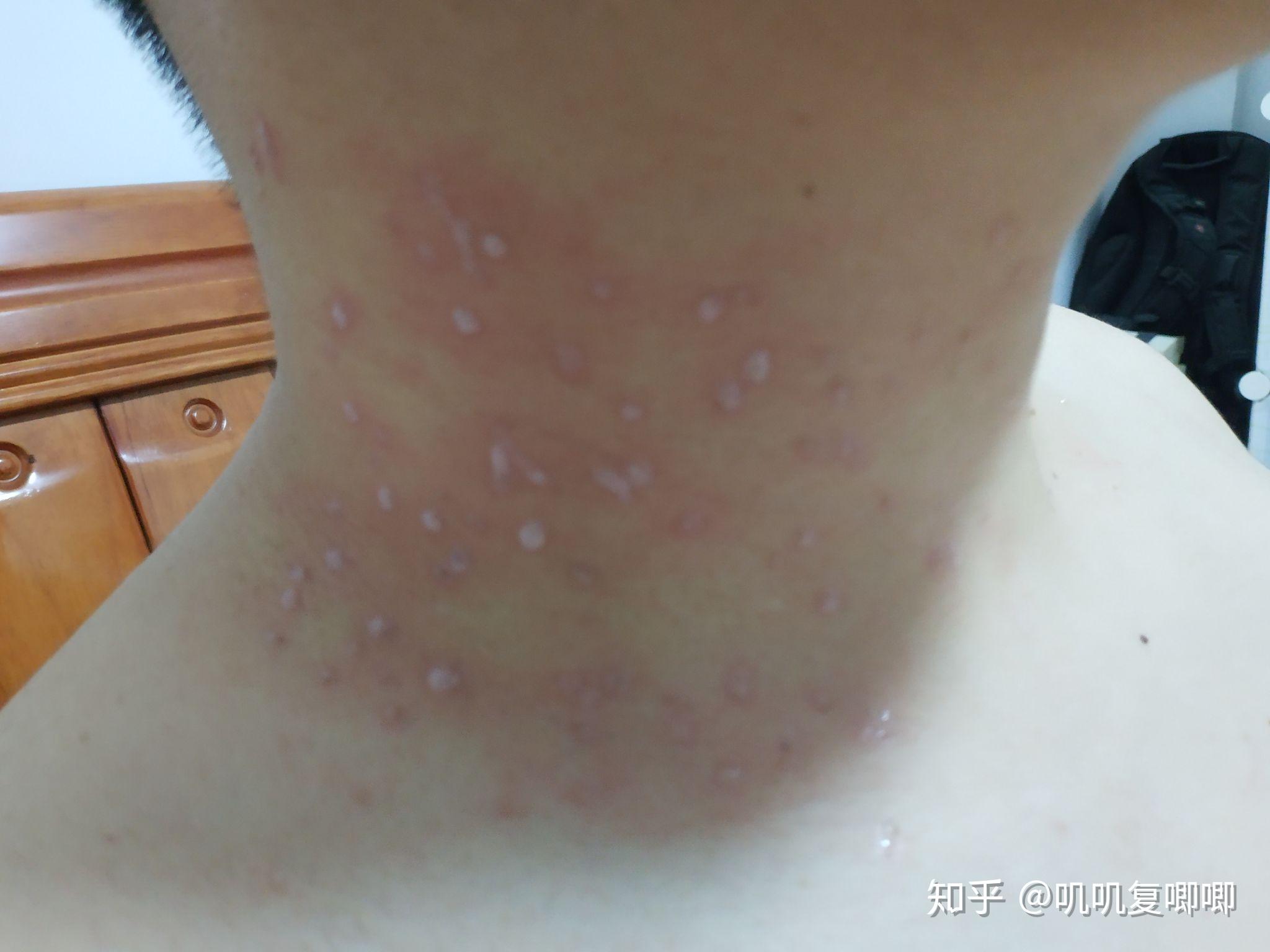 丝状疣脖子上女性医生说要激光扫有别的办法吗